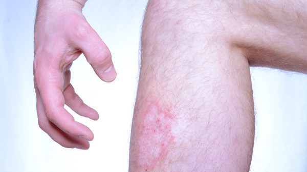 银屑病复发和患者饮食有关吗?