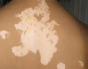 白癜风会引起皮肤出现瘙痒吗?