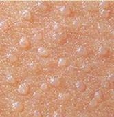 扁平疣可以冷冻治疗吗，要注意哪些事项?