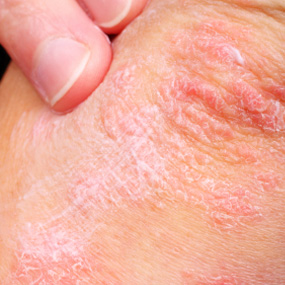 体癣会引起患者皮肤出现瘙痒吗?