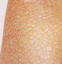 鱼鳞病会引起头皮屑增多吗?