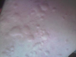 荨麻疹会反反复复好几次吗?