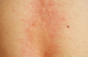 荨麻疹为什么晚上痒的严重呢?