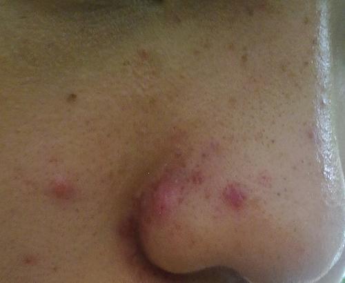 痤疮是因为皮肤感染细菌原因吗?