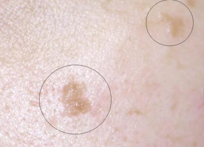 寻常疣一般好发于什么部位上呢?