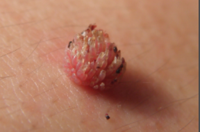 湿疣是不是会越来越多呢?