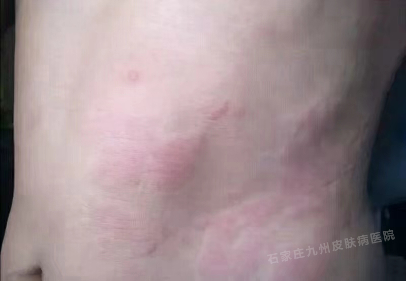 荨麻疹症状损害会不会全身都有呢?