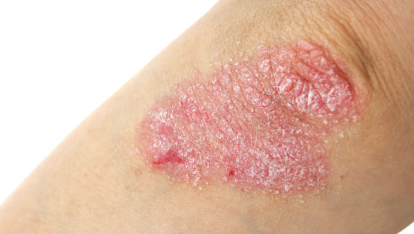 牛皮癣为什么晚上睡觉痒的狠?