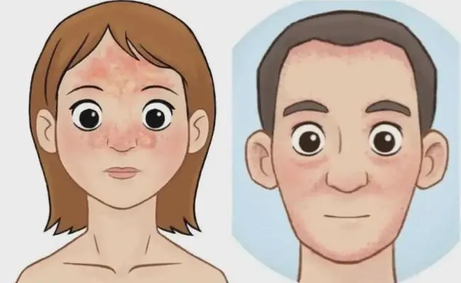 脂溢性皮炎会出现在面部吗?