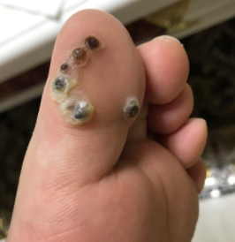 跖疣是不是只在脚上呢?