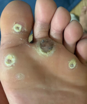 跖疣和鸡眼应当如何区分呢?