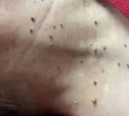 丝状疣是什么hpv病毒类型引起的?