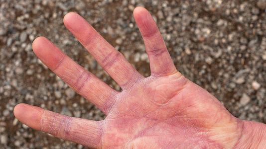 手癣会引起手上出现水泡吗?