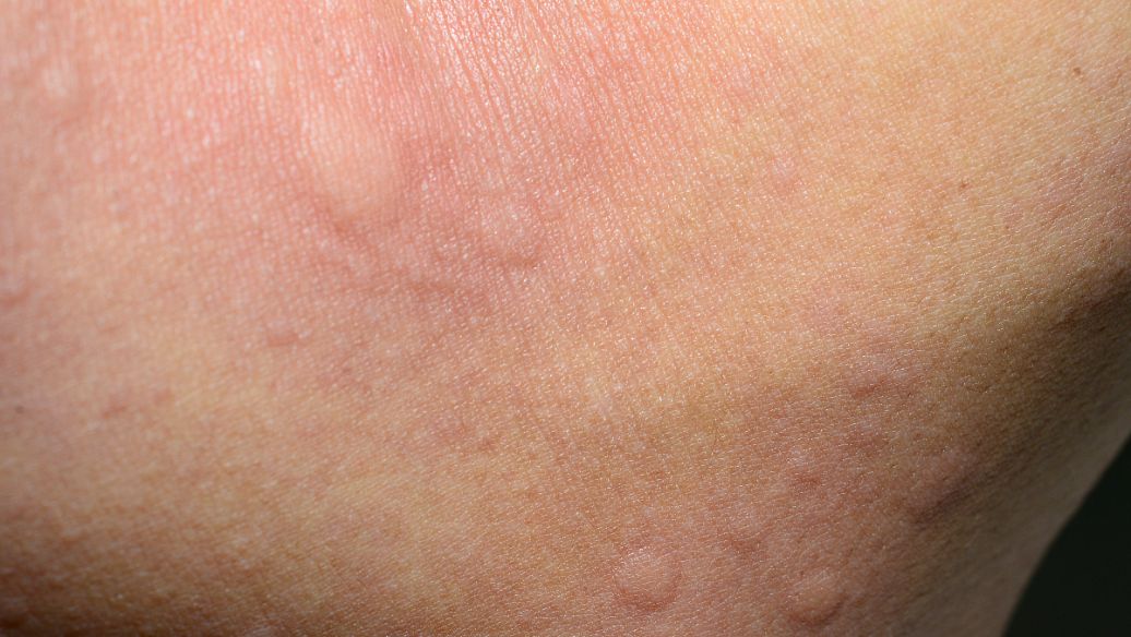 扁平疣症状损害会自行消退吗?