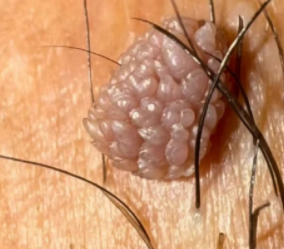 湿疣要怎么检查出来呢?