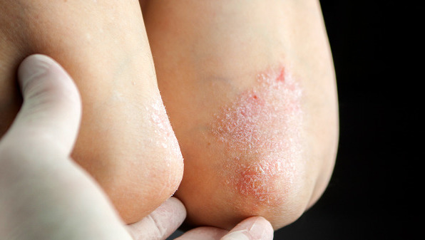 神经性皮炎会引起皮肤刺痛感吗?