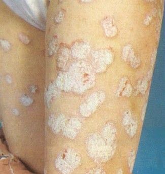 牛皮癣和湿疹应当如何区别?