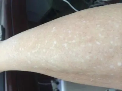 身上有白点是不是白癜风症状呢?