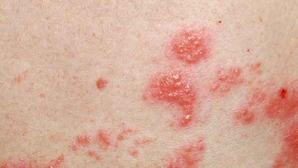 带状疱疹可以使用炉甘石洗剂吗?