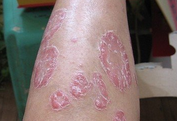 寻常型银屑病要注意哪些事项呢?