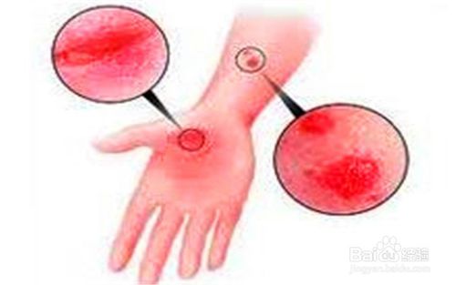 湿疹会出现在私密部位吗?