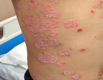 牛皮癣会扩散到全身皮肤吗?