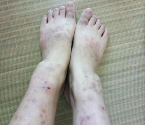 湿疹会长在脚上吗，有什么症状原因?