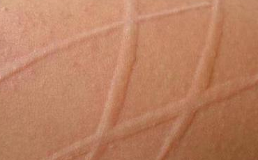 人工性荨麻疹有什么特征和表现?