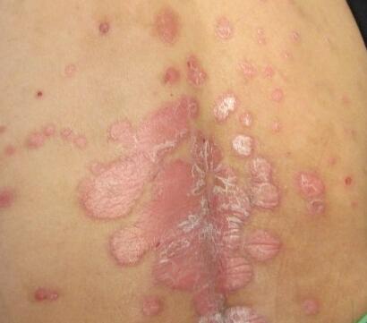 牛皮癣会出现色素变化吗?