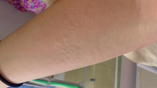 荨麻疹和皮肤过敏应当怎么辨别?