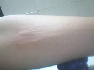 皮肤过敏会引起淋巴结肿大吗?