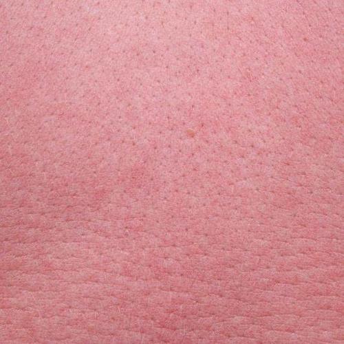 湿疹和紫癜应当如何区分辨别?