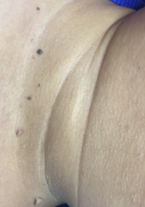 丝状疣是不是传染性很强呢?