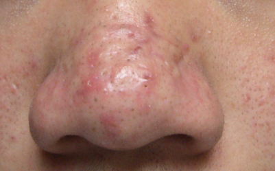 青春期过后还会再长青春痘吗?