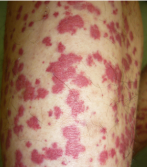 过敏性紫癜好发于什么年龄?