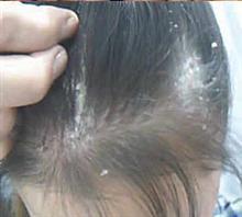 头癣会引起脱发现象吗?