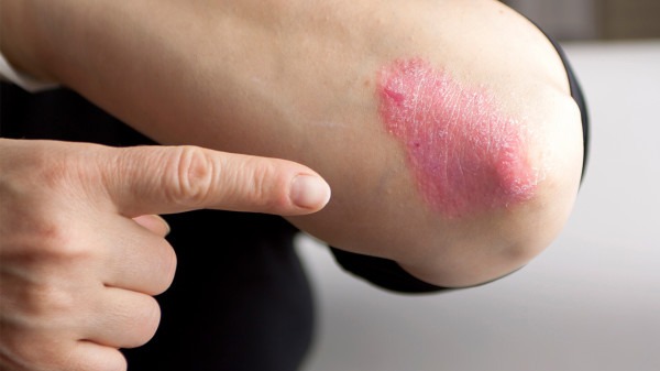 牛皮癣患者饮食上需要注意哪些食物?