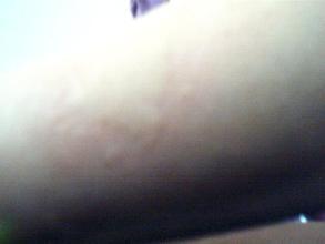 荨麻疹消退后还会再复发吗?