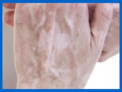 反复性白癜风都是什么原因呢?