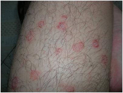 银屑病治疗的目标都有哪些呢?