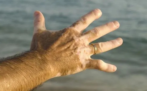 白癜风和无色素痣有什么区别?