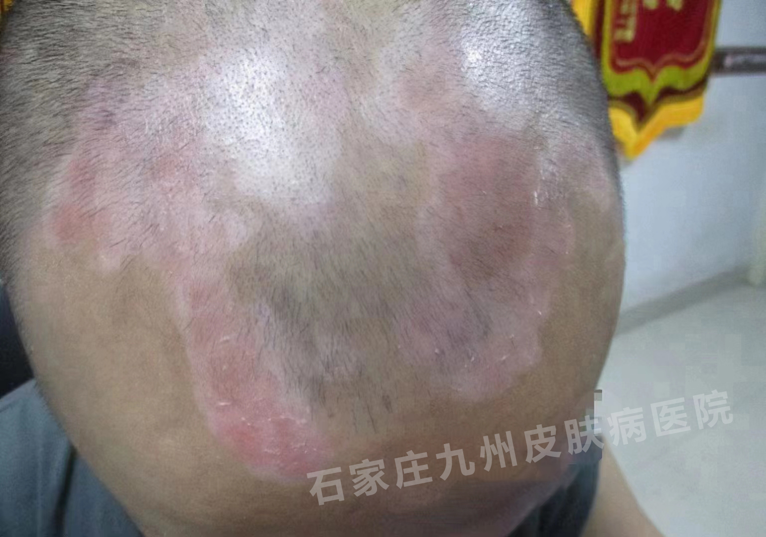 白癜风症状和损害会长在头皮上吗?