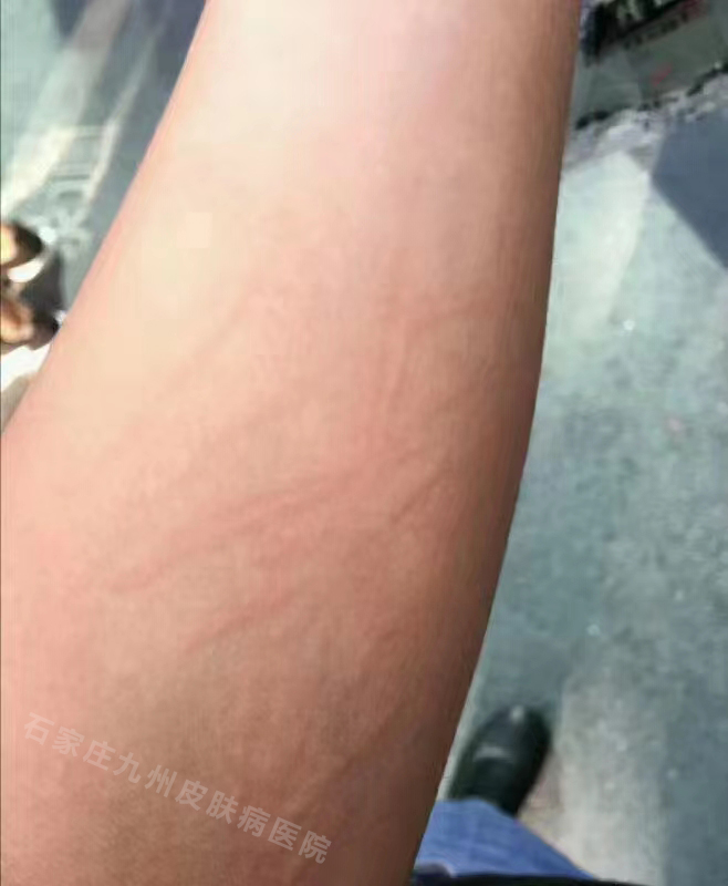 皮肤过敏引起的红斑会留痕迹吗?