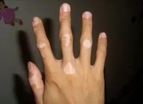 白癜风在伍德灯下是什么颜色呢?