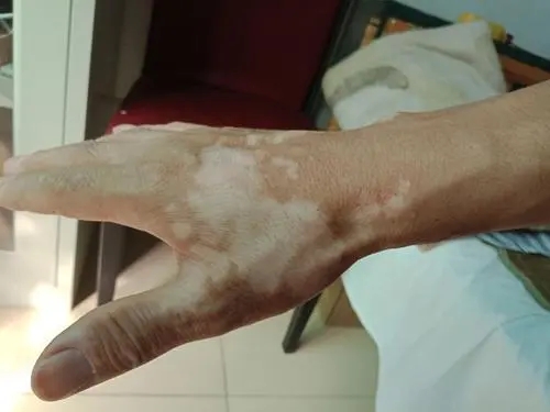 白癜风的颜色会有哪些变化呢?