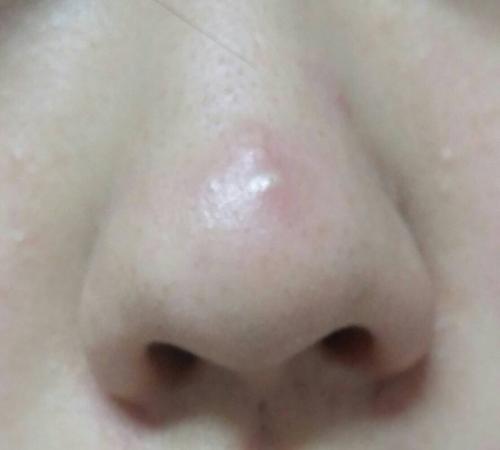 痤疮和马拉色菌毛囊炎要如何区分?