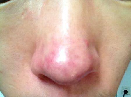 酒糟鼻和黑头粉刺要如何区分?
