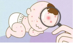 过敏性紫癜是不是遗传所得?