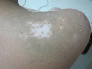 白癜风和精神压力大有关系吗?