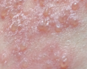 生殖疱疹病毒和hpv有关系吗?